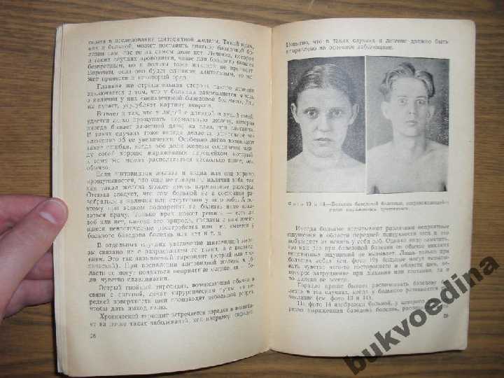 Рудницкий М.Г., Чумаков И.И. Базедова болезнь 1957 - фото фото фото 3