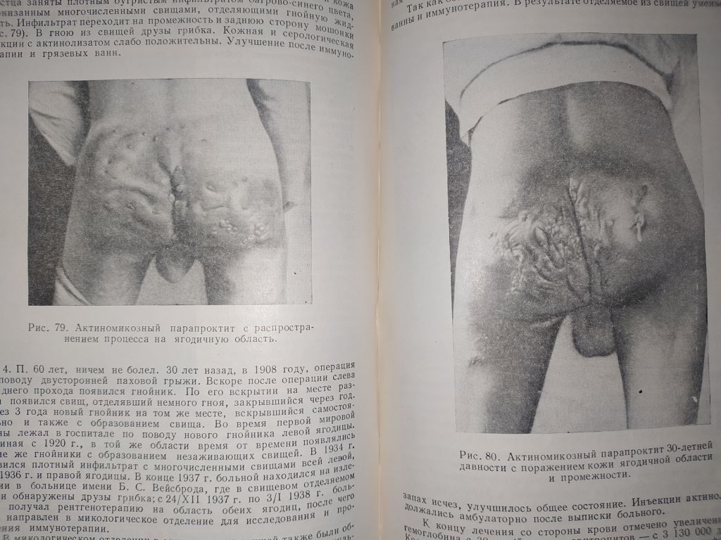 книга: АКТИНОМИКОЗ. МОРФОЛОГИЯ, КЛИНИКА, ТЕРАПИЯ.  авт.: Проф. Г.О.Сутеев  1951г. - фото фото фото 7