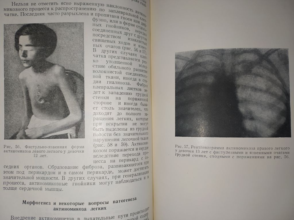 книга: АКТИНОМИКОЗ. МОРФОЛОГИЯ, КЛИНИКА, ТЕРАПИЯ.  авт.: Проф. Г.О.Сутеев  1951г. - фото фото фото 6