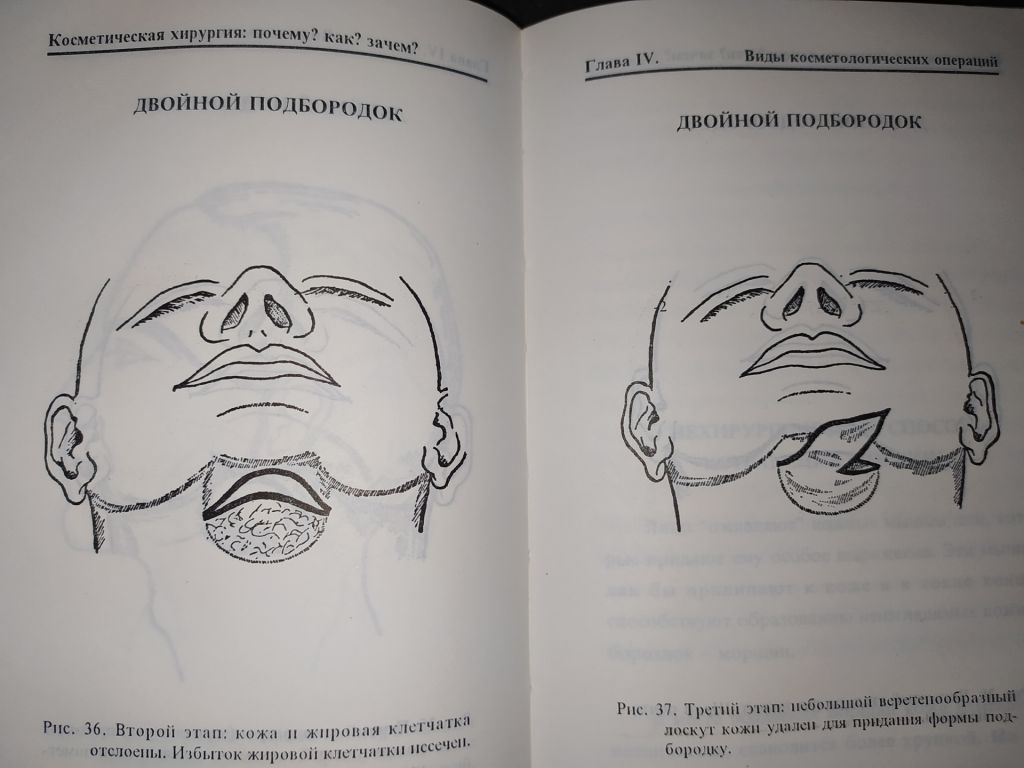 книга: КОСМЕТИЧЕСКАЯ ХИРУРГИЯ. by Dr. Jean-Mark Subiran 1995г. - фото фото фото 9