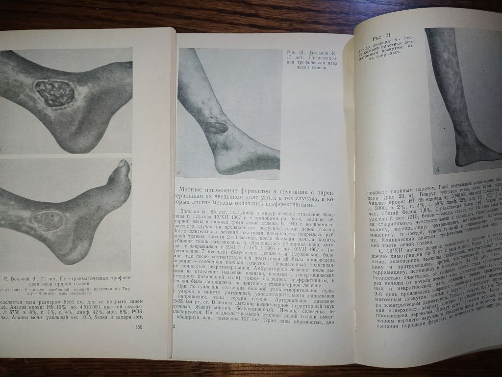 книги: ТРОФИЧЕСКИЕ ЯЗВЫ. ПАТОГЕНЕЗ, КЛИНИКА, ЛЕЧЕНИЕ 1972г. - фото фото фото 7