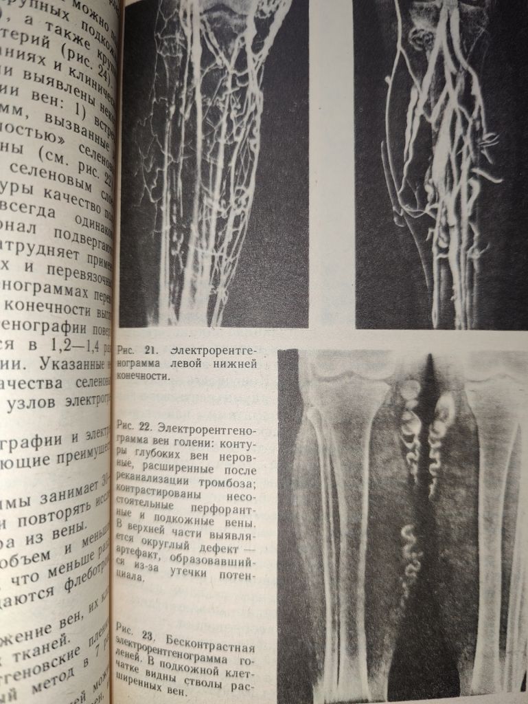 книга: БОЛЕЗНИ ВЕН И ЛИМФАТИЧЕСКОЙ СИСТЕМЫ КОНЕЧНОСТЕЙ 1984г. - фото фото фото 4