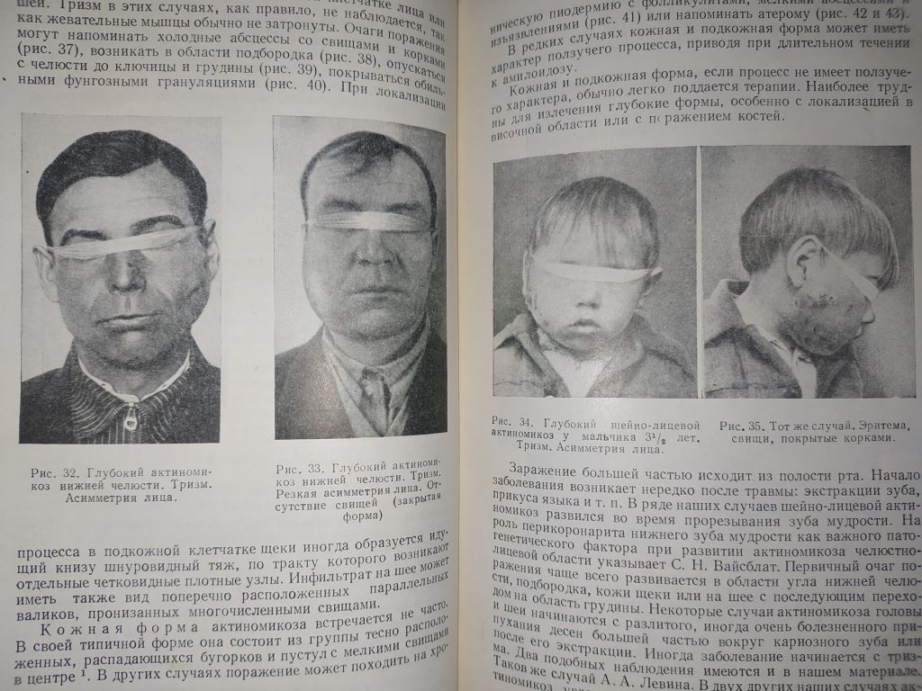 книга: АКТИНОМИКОЗ. МОРФОЛОГИЯ, КЛИНИКА, ТЕРАПИЯ.  авт.: Проф. Г.О.Сутеев  1951г. - фото фото фото 4