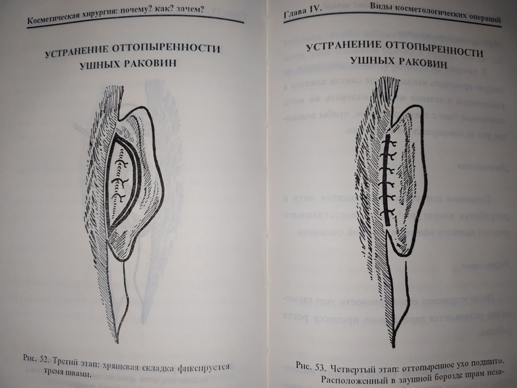 книга: КОСМЕТИЧЕСКАЯ ХИРУРГИЯ. by Dr. Jean-Mark Subiran 1995г. - фото фото фото 13