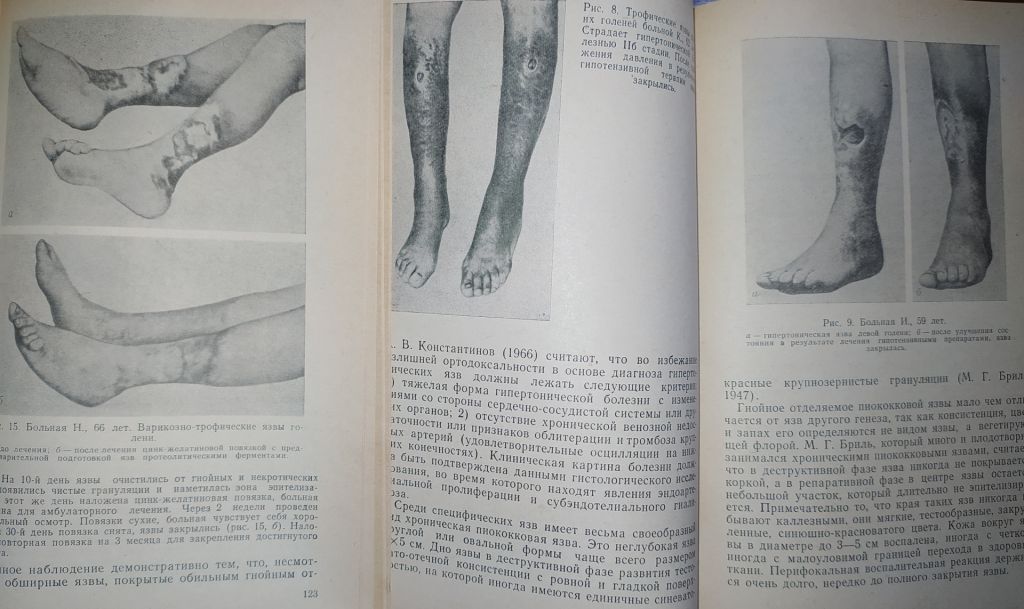 книги: ТРОФИЧЕСКИЕ ЯЗВЫ. ПАТОГЕНЕЗ, КЛИНИКА, ЛЕЧЕНИЕ 1972г. - фото фото фото 4