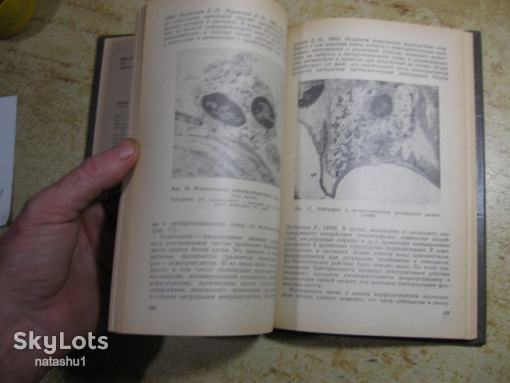 микроэмболии легких 1986г - фото фото фото 6