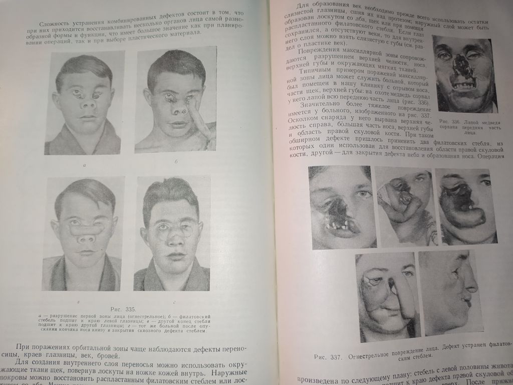 книга: ВОССТАНОВИТЕЛЬНЫЕ ОПЕРАЦИИ ЧЕЛЮСТНО-ЛИЦЕВОЙ ОБЛАСТИ 1962г. - фото фото фото 8