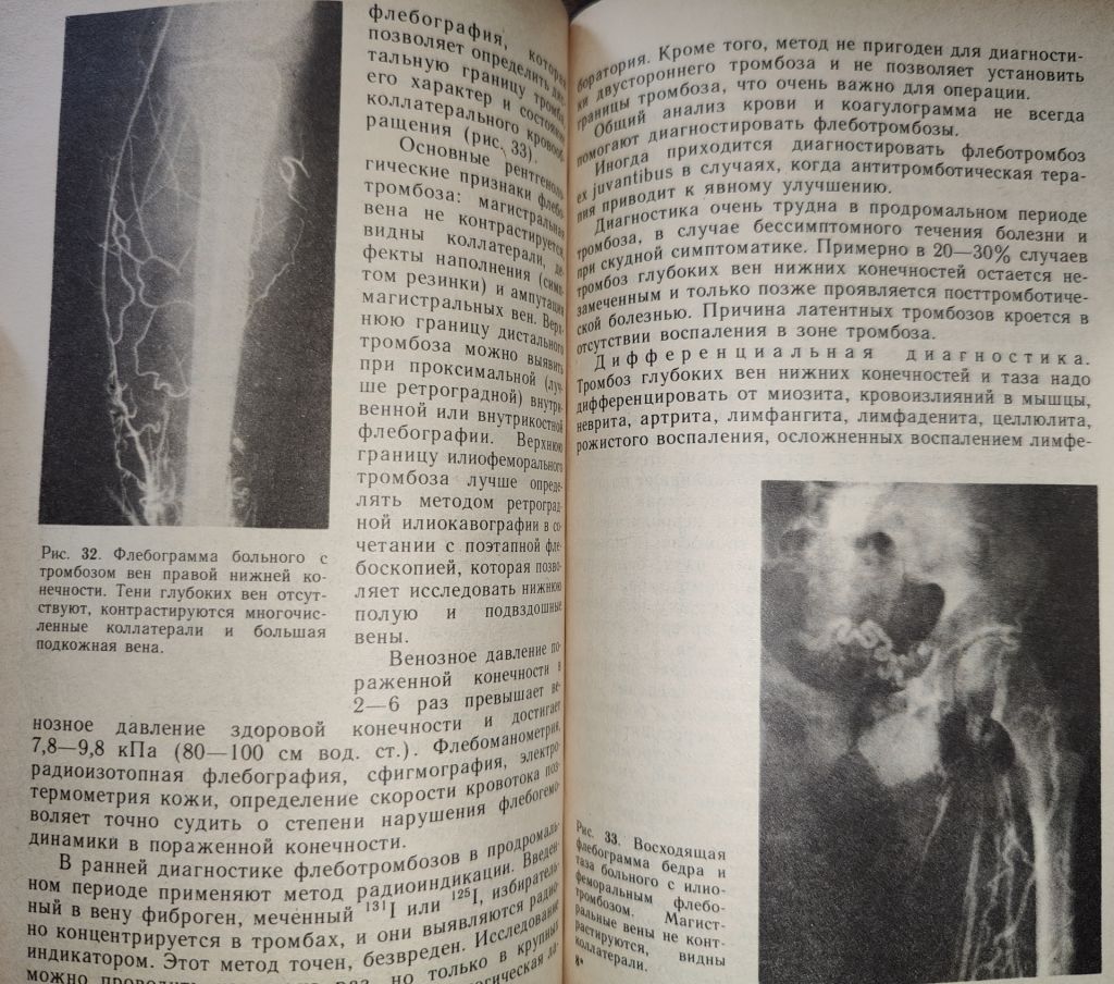 книга: БОЛЕЗНИ ВЕН И ЛИМФАТИЧЕСКОЙ СИСТЕМЫ КОНЕЧНОСТЕЙ 1984г. - фото фото фото 5