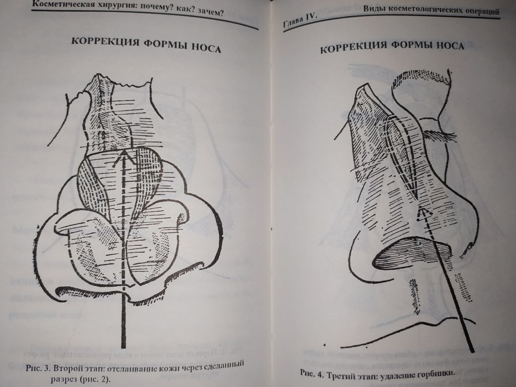 книга: КОСМЕТИЧЕСКАЯ ХИРУРГИЯ. by Dr. Jean-Mark Subiran 1995г. - фото фото фото 11