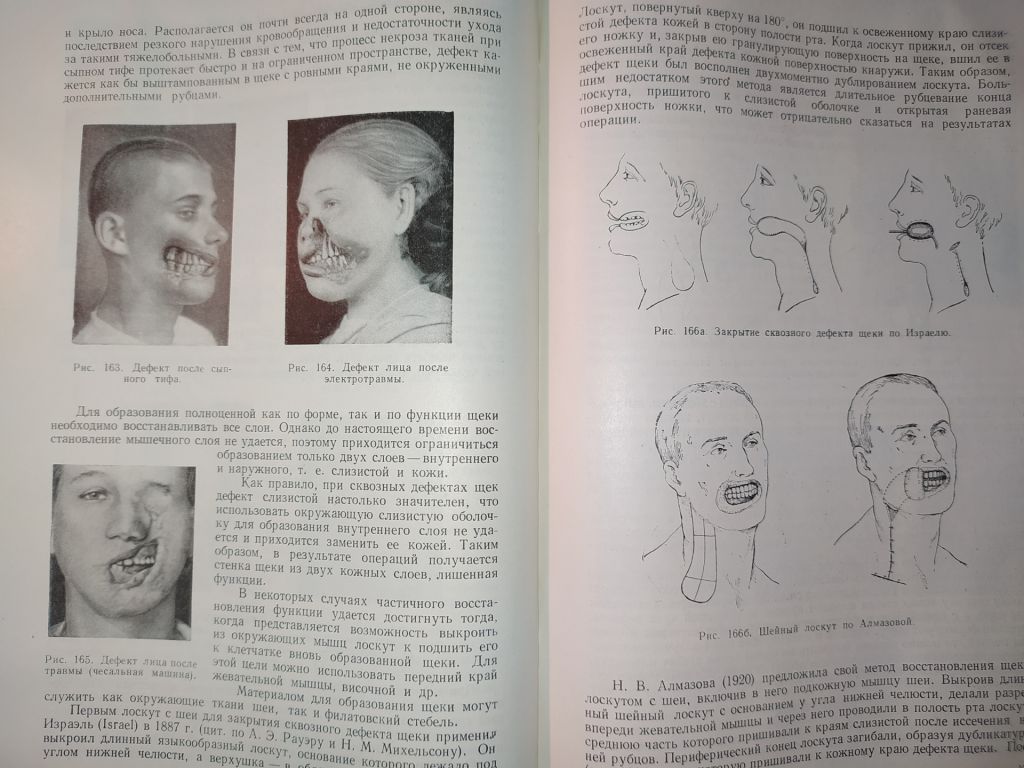 книга: ВОССТАНОВИТЕЛЬНЫЕ ОПЕРАЦИИ ЧЕЛЮСТНО-ЛИЦЕВОЙ ОБЛАСТИ 1962г. - фото фото фото 6