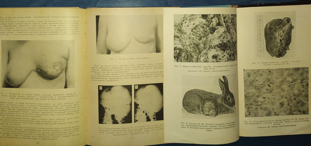 книги: ОПЕРАЦИИ НА НАДПОЧЕЧНИКАХ. 1971г. ПРОФИЛАКТИКА, ДИАГНОСТИКА И ТЕРАПИЯ РАКА 1965г. - фото фото фото 7