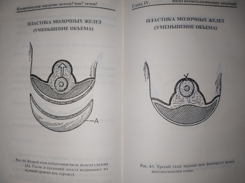 книга: КОСМЕТИЧЕСКАЯ ХИРУРГИЯ. by Dr. Jean-Mark Subiran 1995г. - фото фото фото 5