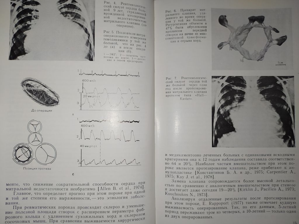 книга: БИОЛОГИЧЕСКИЕ ПРОТЕЗЫ КЛАПАНОВ СЕРДЦА 1988г. - фото фото фото 5
