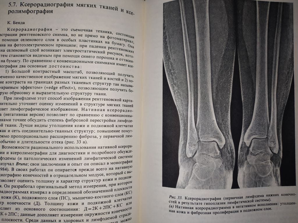 книга: ЛИМФЭДЕМА КОНЕЧНОСТЕЙ 1987г. - фото фото фото 7