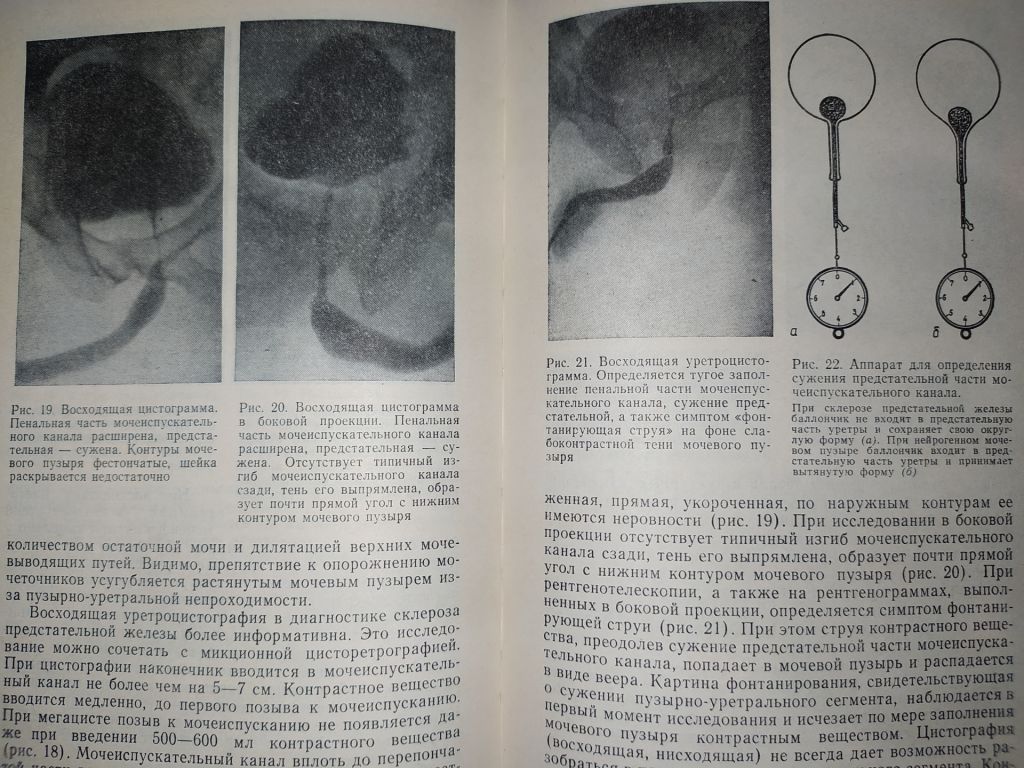 книга: СКЛЕРОЗ ПРЕДСТАТЕЛЬНОЙ ЖЕЛЕЗЫ 1985г. - фото фото фото 6
