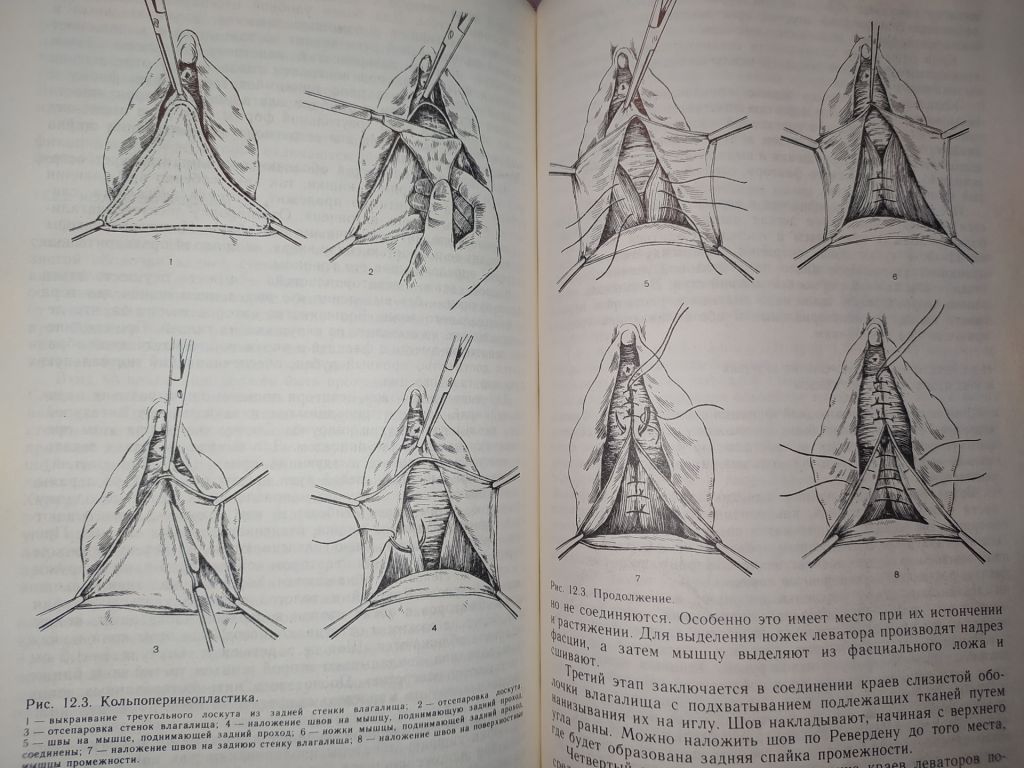 книга: ОПЕРАТИВНАЯ ГИНЕКОЛОГИЯ. Руководство для врачей 1990г. - фото фото фото 9