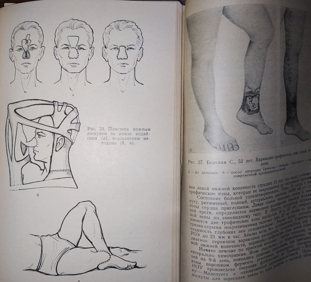 книги: ТРОФИЧЕСКИЕ ЯЗВЫ. ПАТОГЕНЕЗ, КЛИНИКА, ЛЕЧЕНИЕ 1972г. - фото фото фото 6