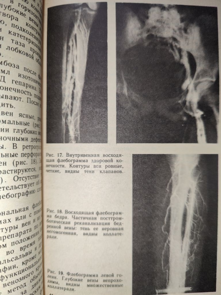 книга: БОЛЕЗНИ ВЕН И ЛИМФАТИЧЕСКОЙ СИСТЕМЫ КОНЕЧНОСТЕЙ 1984г. - фото фото фото 6