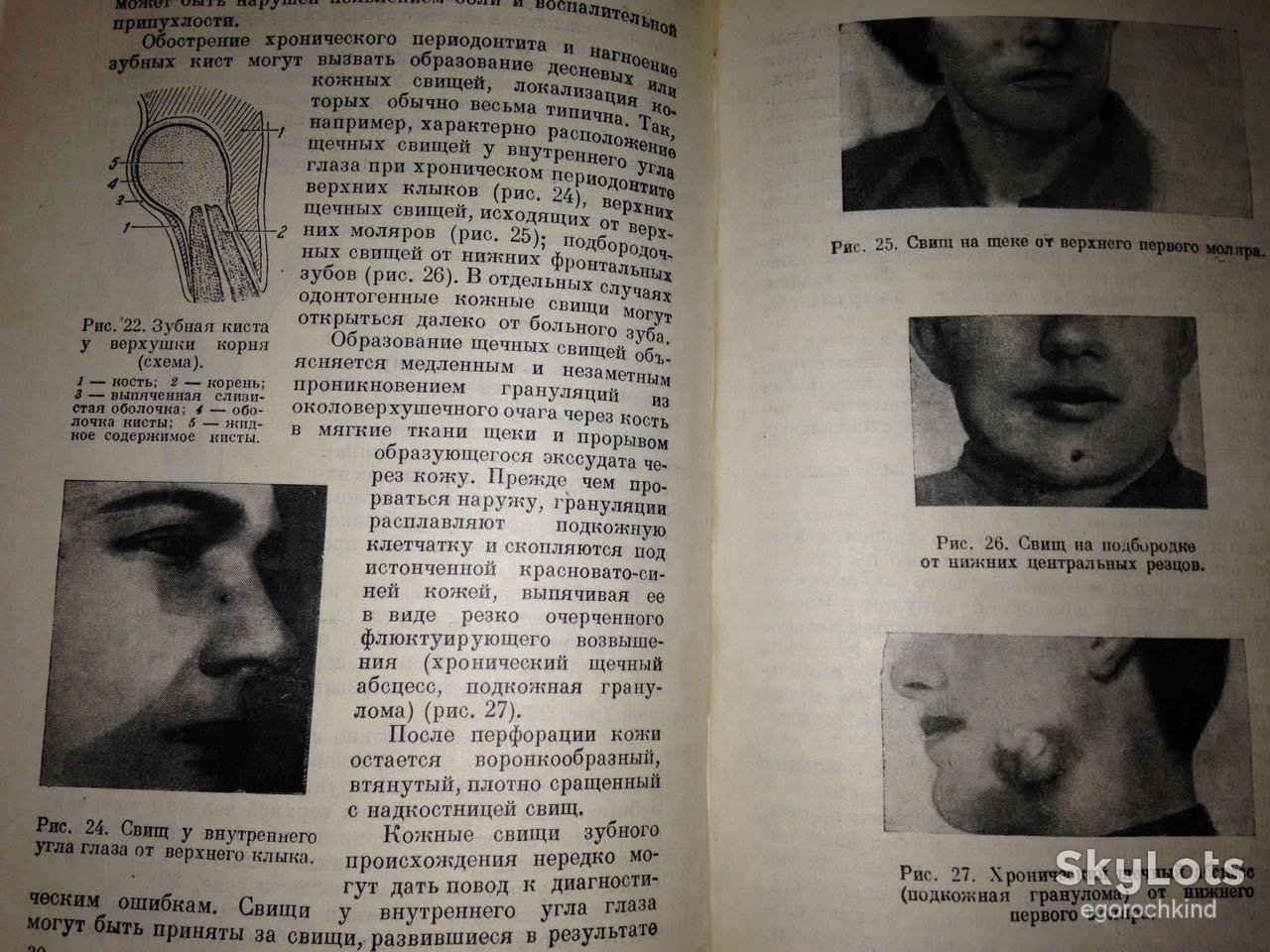 книга: БОЛЕЗНИ ЗУБОВ, ЧЕЛЮСТЕЙ И РТА 1949г. - фото фото фото 8