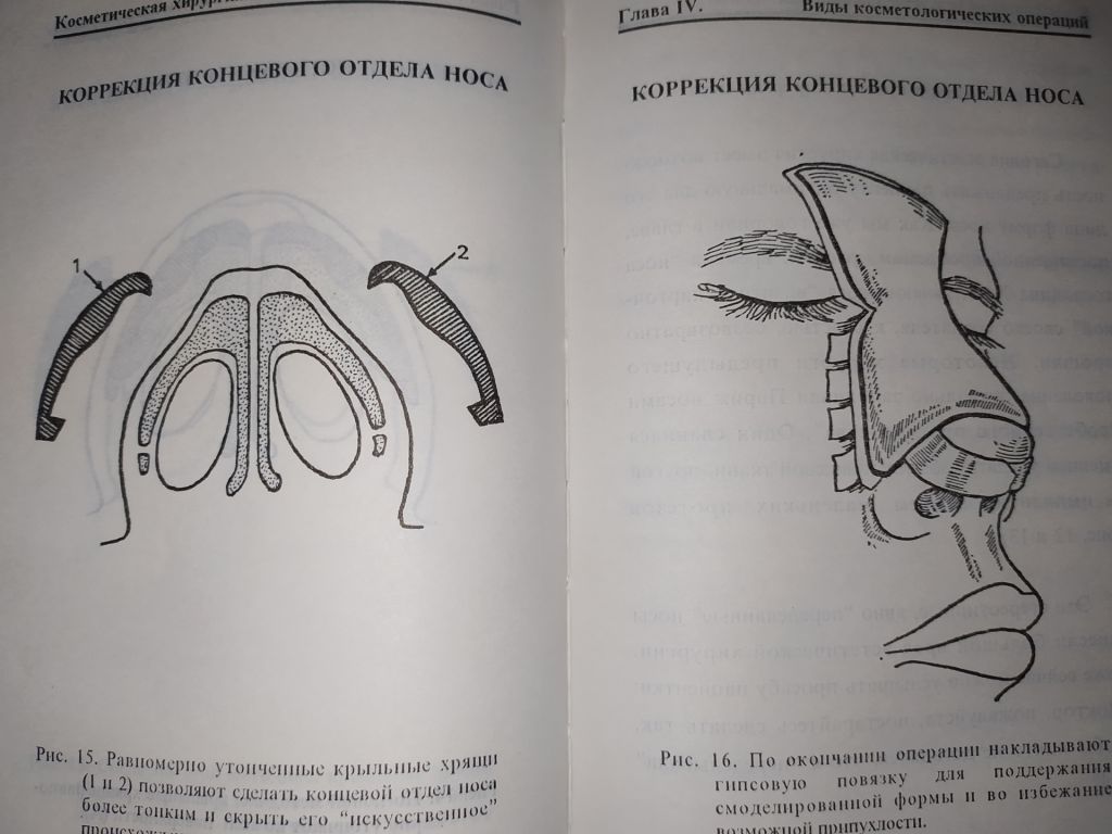 книга: КОСМЕТИЧЕСКАЯ ХИРУРГИЯ. by Dr. Jean-Mark Subiran 1995г. - фото фото фото 7