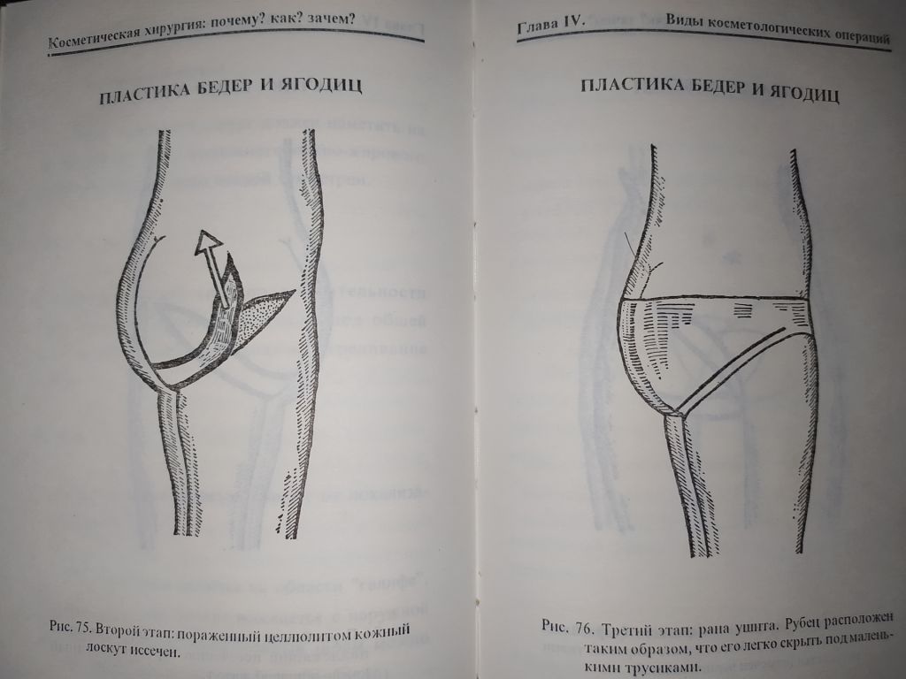 книга: КОСМЕТИЧЕСКАЯ ХИРУРГИЯ. by Dr. Jean-Mark Subiran 1995г. - фото фото фото 6