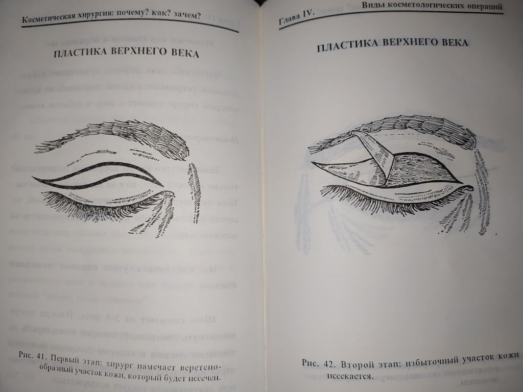 книга: КОСМЕТИЧЕСКАЯ ХИРУРГИЯ. by Dr. Jean-Mark Subiran 1995г. - фото фото фото 10