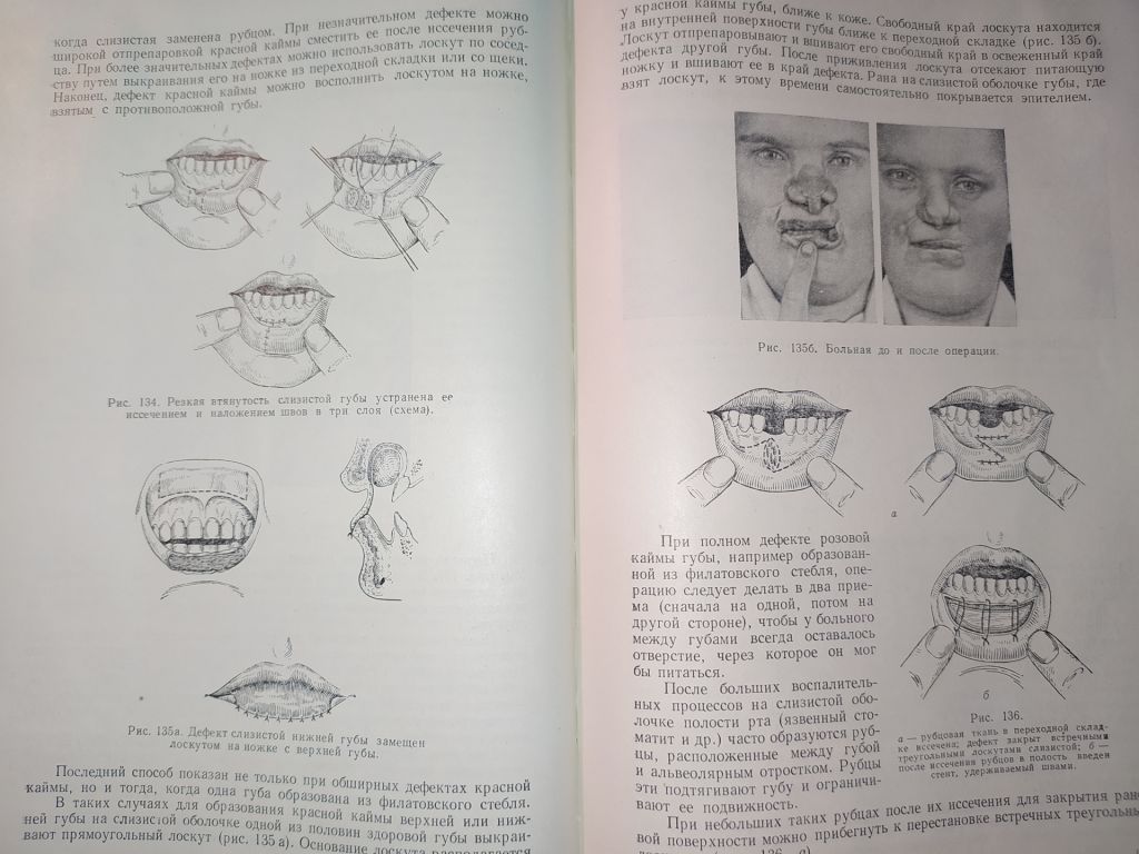 книга: ВОССТАНОВИТЕЛЬНЫЕ ОПЕРАЦИИ ЧЕЛЮСТНО-ЛИЦЕВОЙ ОБЛАСТИ 1962г. - фото фото фото 11