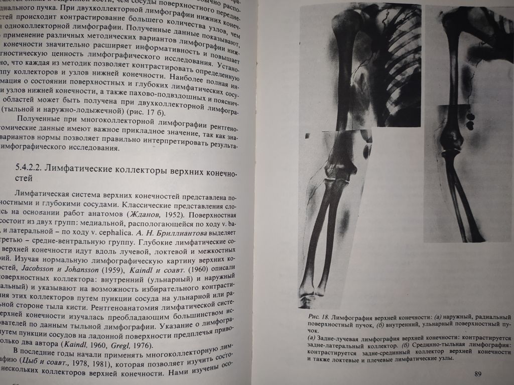 книга: ЛИМФЭДЕМА КОНЕЧНОСТЕЙ 1987г. - фото фото фото 8