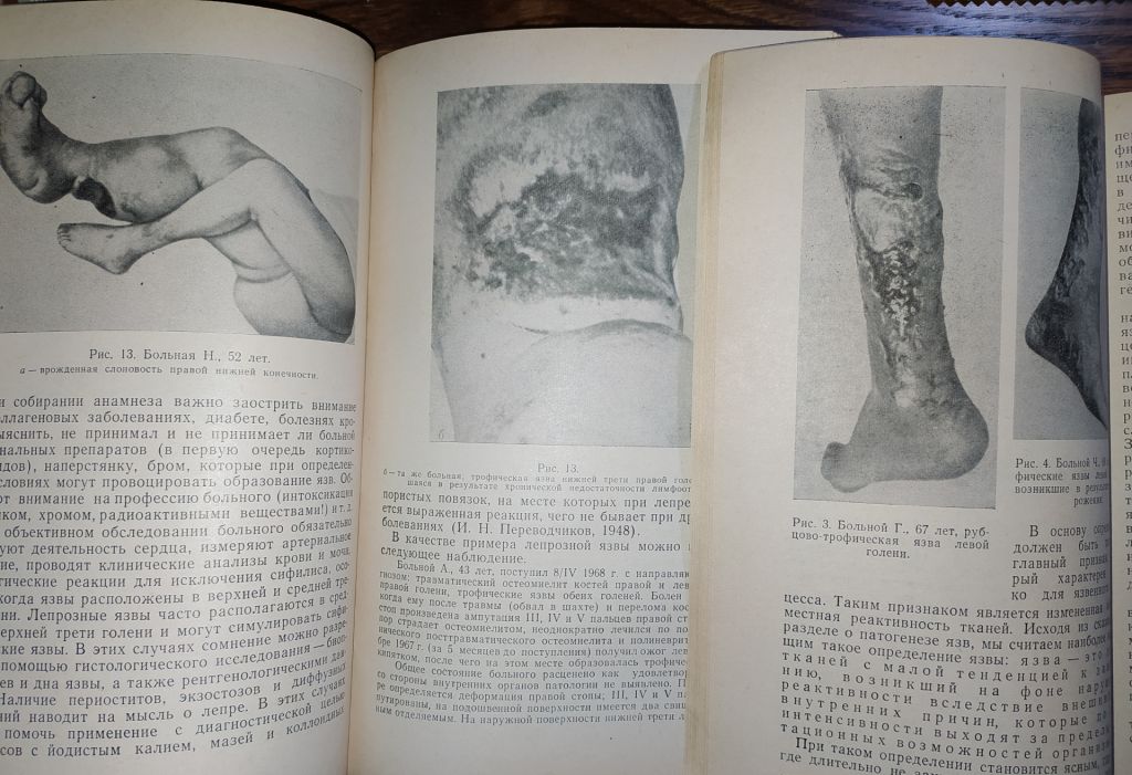 книги: ТРОФИЧЕСКИЕ ЯЗВЫ. ПАТОГЕНЕЗ, КЛИНИКА, ЛЕЧЕНИЕ 1972г. - фото фото фото 3
