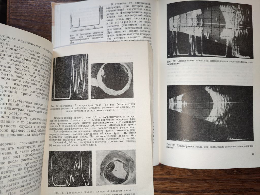 книги: УЛЬТРАЗВУК В ОФТАЛЬМОЛОГИИ 1987г. УЛЬТРАЗВУК В ОФТАЛЬМОЛОГИИ 1973г. - фото фото фото 5